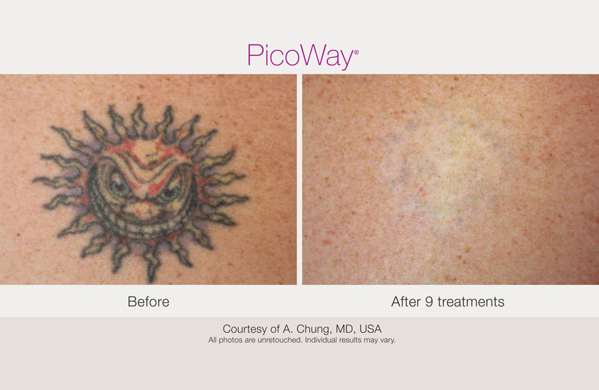 PicoWay Laser Tattoo Removal in Nanaimo