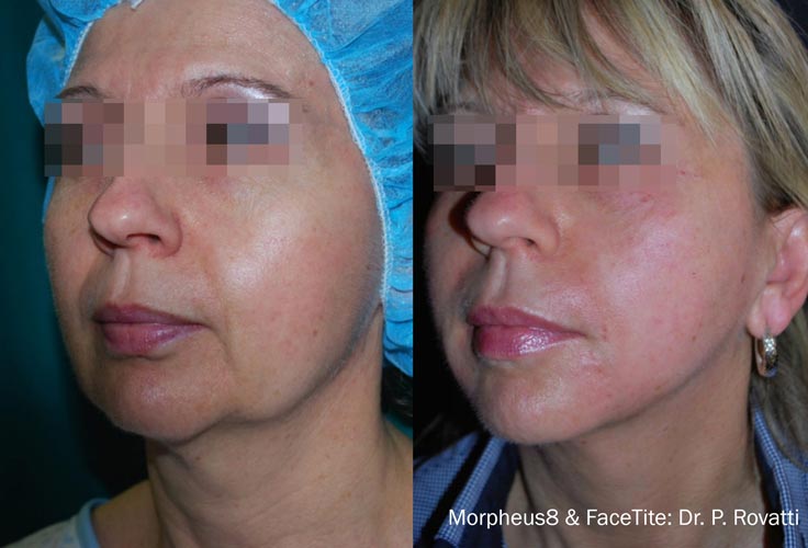 morpheus-facetite-before-after-dr-p-rovatti-preview-1