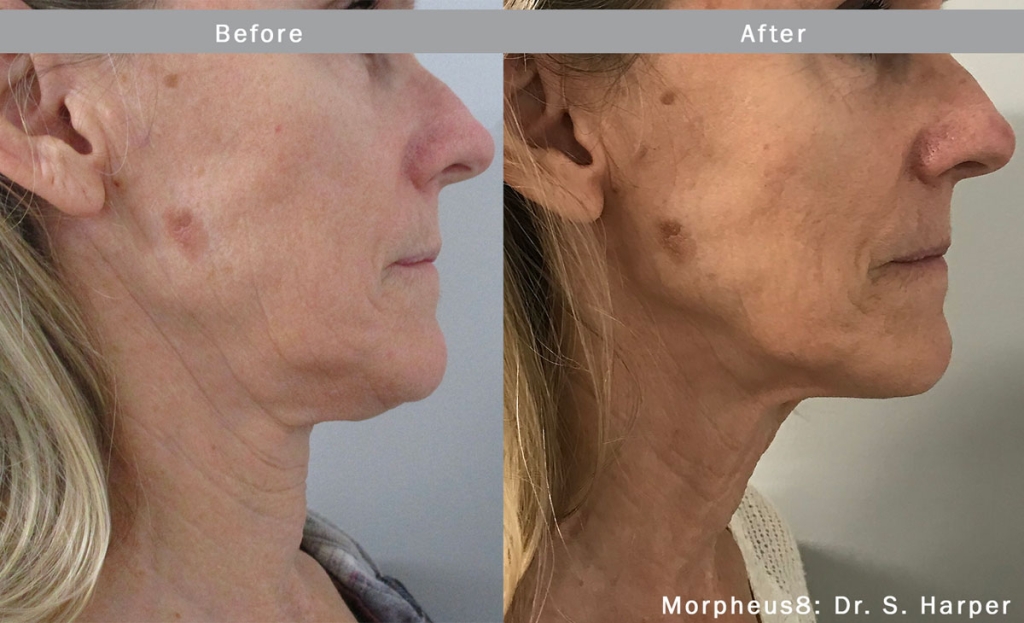 morpheus8-face-neck-before-after-4