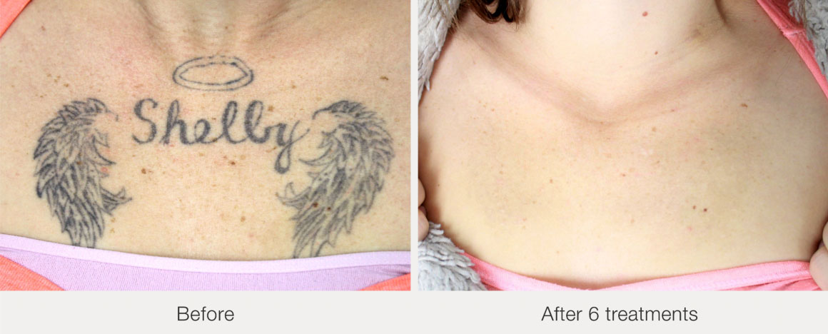 PicoWay laser tattoo removal before & after 6 months