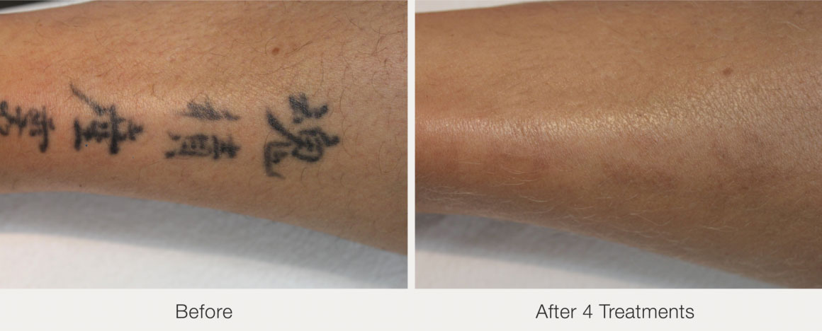 PicoWay laser tatto removal before & after