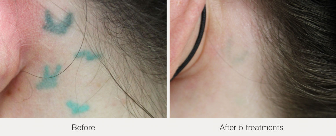 PicoWay laser tattoo removal