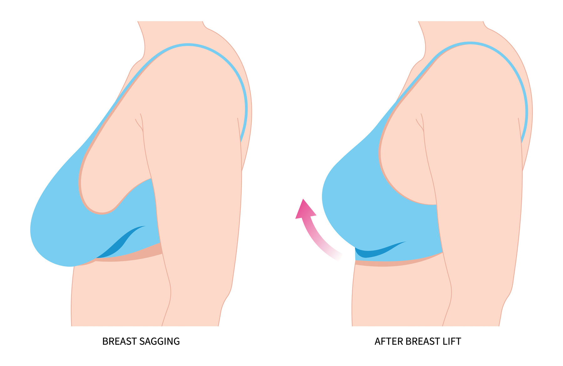 Breast Lift Options, Loftus Plastic Surgery Center