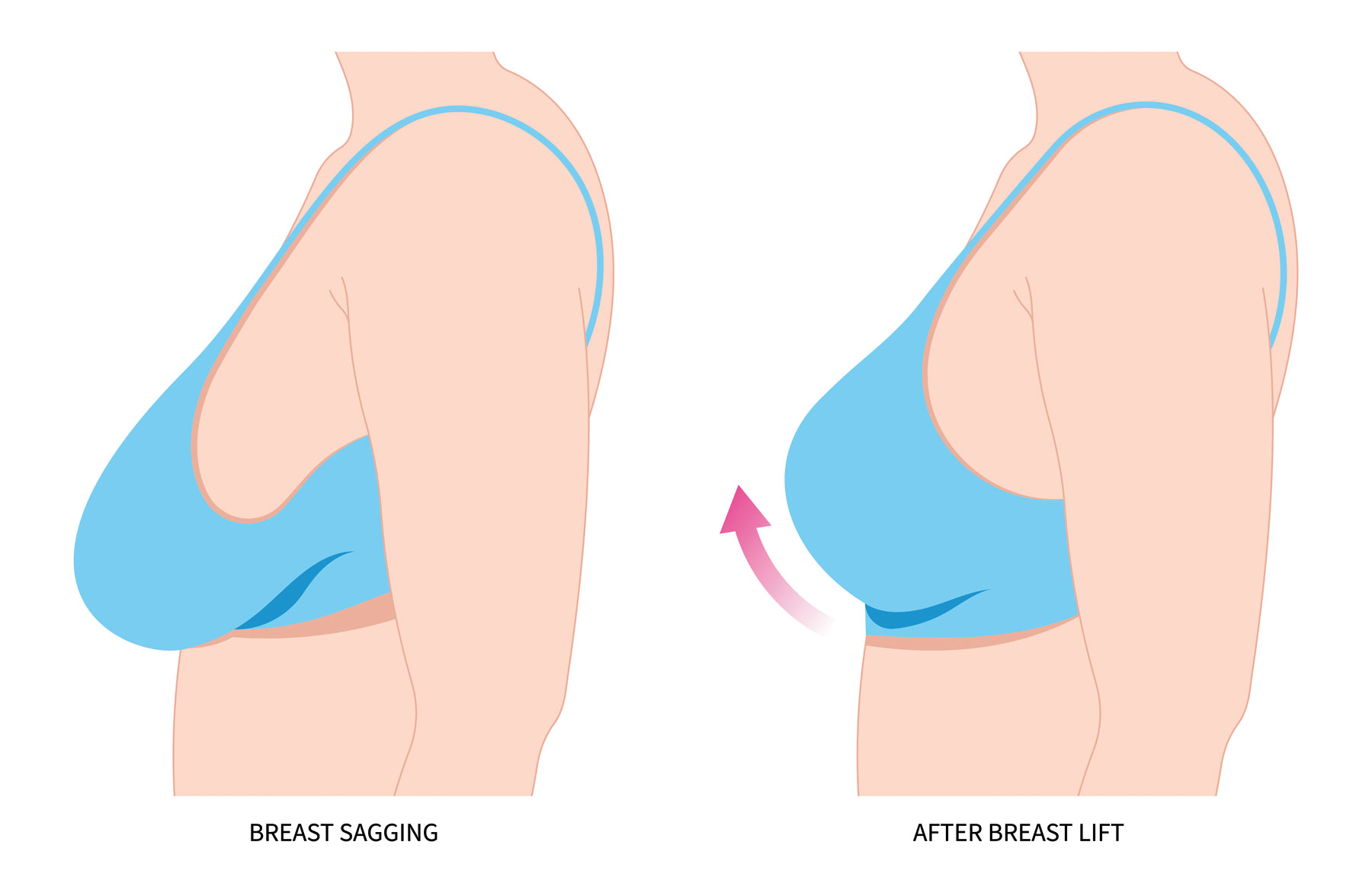 Breast Lift (Mastopexy) – Synergy Medical Aesthetics – Nanaimo