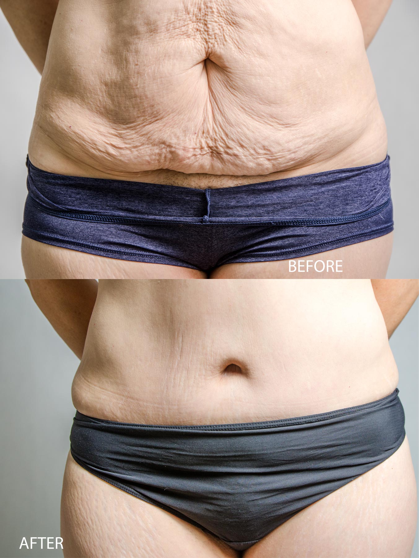 Tummy Tuck - Abdominoplasty